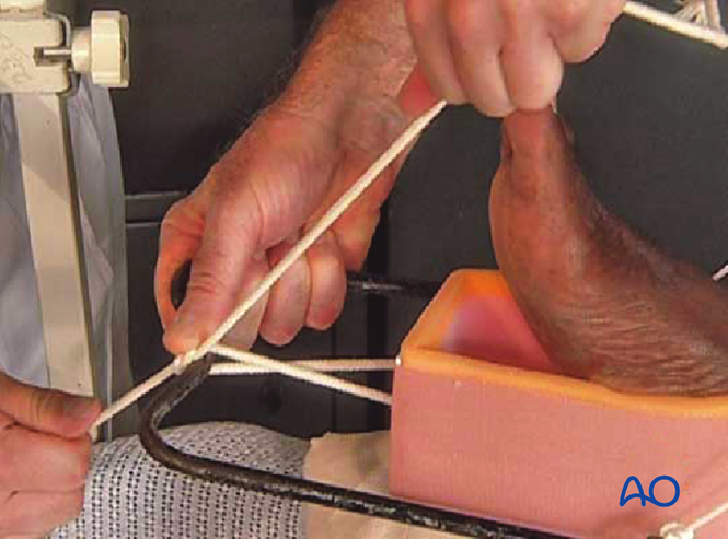 Tsf Splint Temporary Thomas splint for Simple, transverse, middle 1/3 fractures
