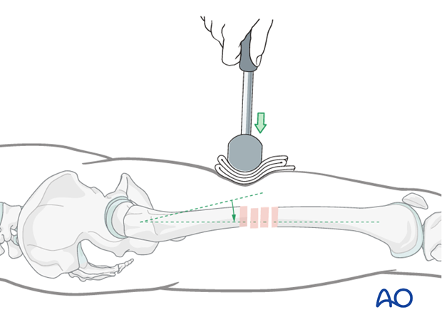 Femoral shaft – Reduction using mallet