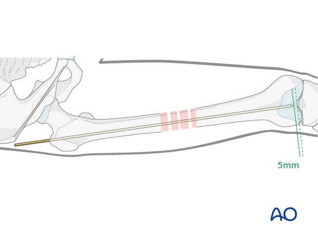 Femoral shaft – Antegrade nailing – Guide wire insertion