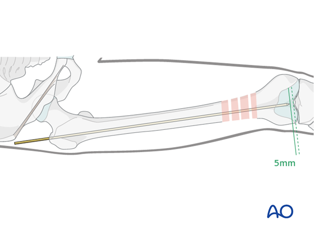 Femoral shaft – Antegrade nailing – Guide wire insertion