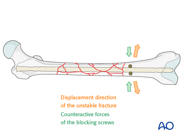 Poller screw (blocking screw) in midshaft fractures