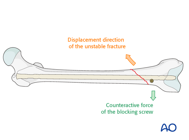 Poller screw (blocking screw) in distal oblique fractures