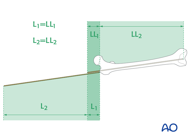 Femoral shaft – Antegrade nailing - Nail length and diameter using guide wire