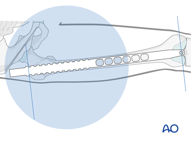 Femoral shaft – Antegrade nailing - Nail length and diameter using radiographic ruler