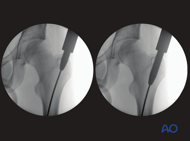 Femoral shaft – Antegrade nailing – Sequential reamer size increase