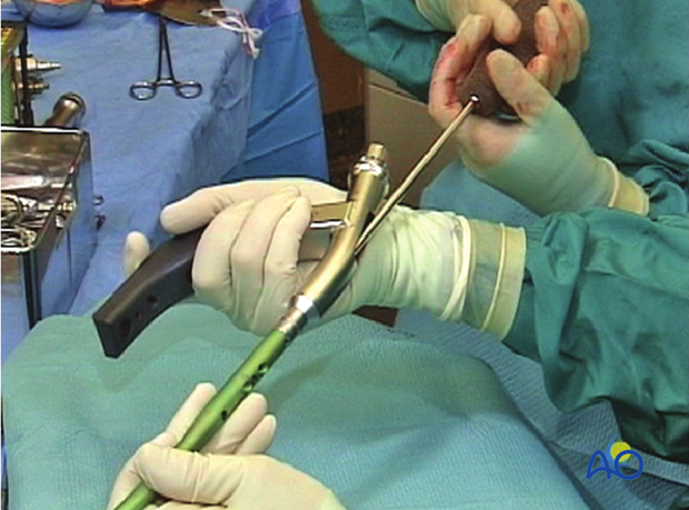 Antegrade nailing – Subtrochanteric femoral fracture – Nail handle