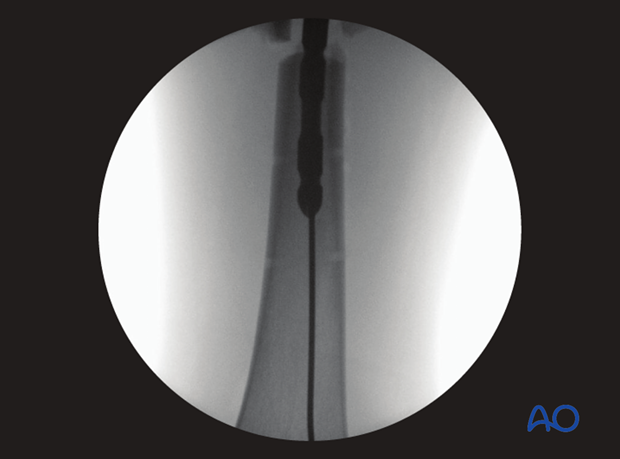 Femoral shaft – Antegrade nailing – Nail passing fracture zone