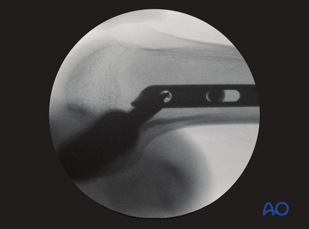 Femoral shaft – Antegrade nailing – Screw insertion for locking