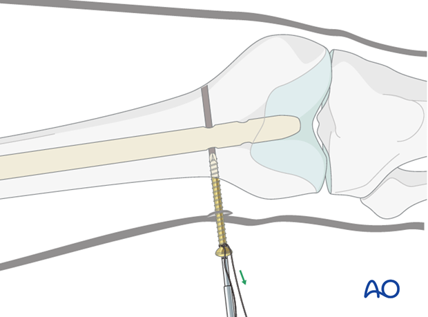 Femoral shaft – Antegrade nailing – Screw insertion pearl
