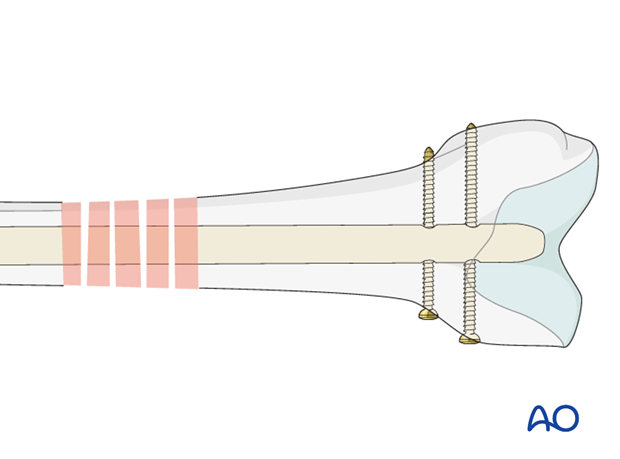 Femoral shaft – Antegrade nailing – Complete distal locking