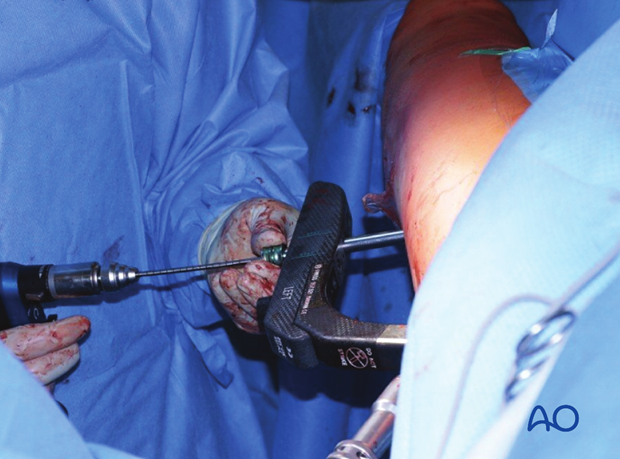 Antegrade nailing – Subtrochanteric femoral fracture – Proximal locking