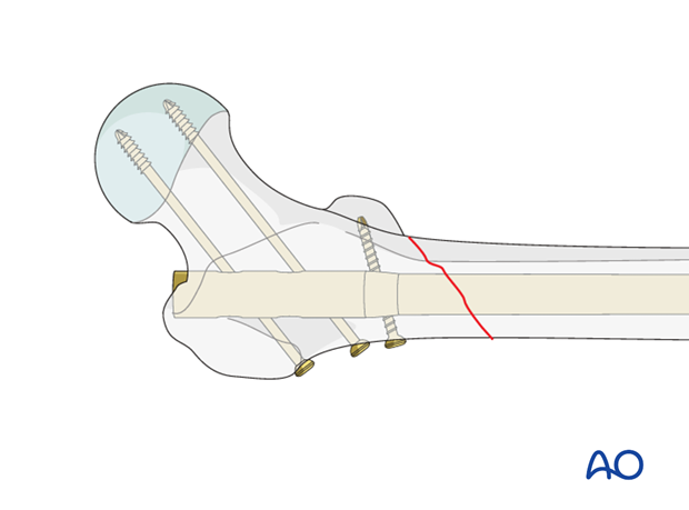 Femoral shaft – Antegrade nailing – Extension of fracture into subtrochanteric region