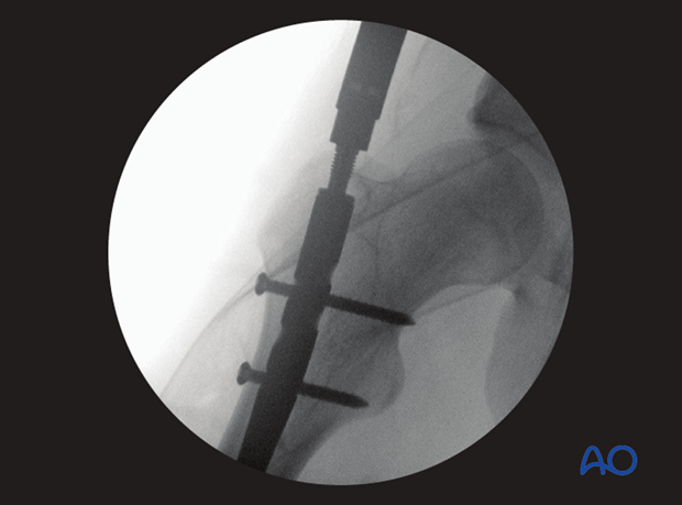 Femoral shaft – Antegrade nailing – Insertion of end cap