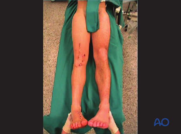 Femoral shaft – Antegrade nailing – Wound closure and assessment of alignment