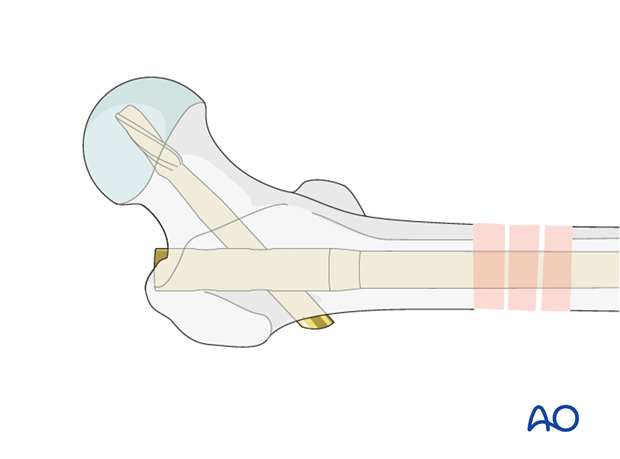 Antegrade nailing – Subtrochanteric femoral fracture