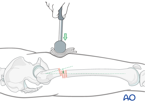 Antegrade nailing – Subtrochanteric femoral fracture – Reduction using mallet