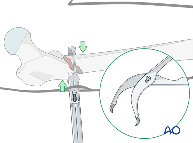 Antegrade nailing – Subtrochanteric femoral fracture – Reduction with pointed reduction forceps