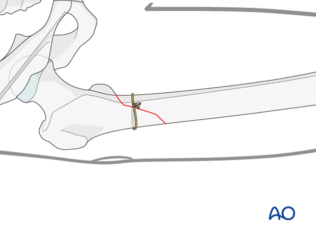 Antegrade nailing – Subtrochanteric femoral fracture – Reduction using cerckage wire