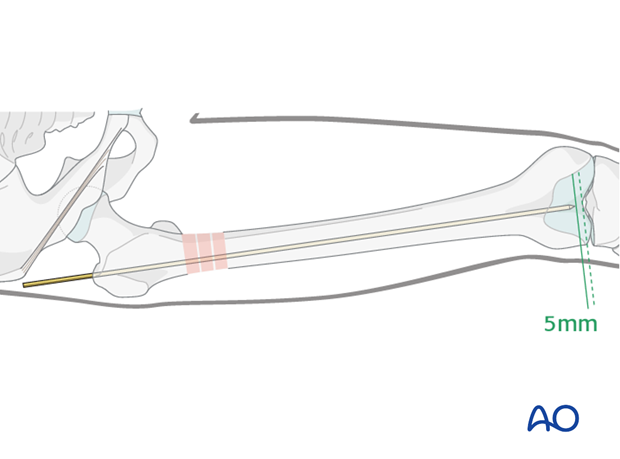 Antegrade nailing – Subtrochanteric femoral fracture – Insertion of guide wire