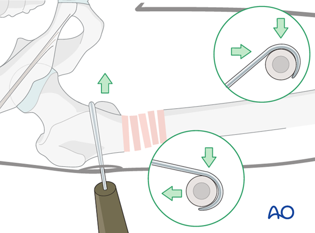 Antegrade nailing – Subtrochanteric femoral fracture – Reduction using bone hook