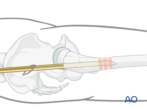 Antegrade nailing – Subtrochanteric femoral fracture – Nail introduction