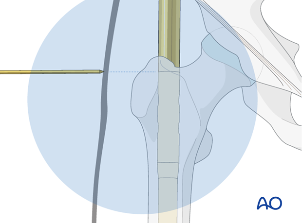 Antegrade nailing – Subtrochanteric femoral fracture – Assessing nail insertion