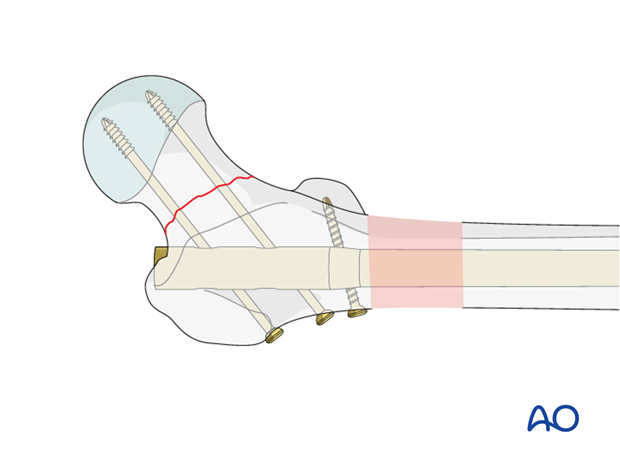 Antegrade nailing – Subtrochanteric femoral fracture – Nail locking - general considerations