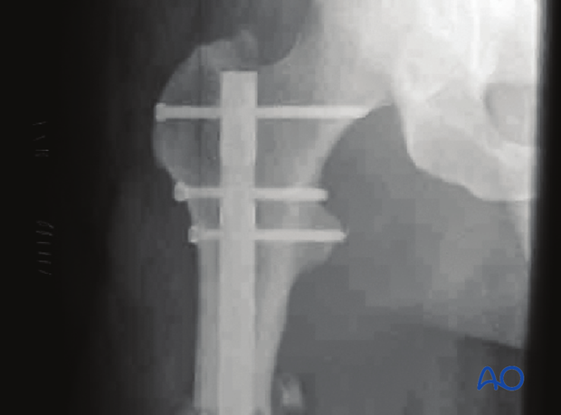 Antegrade nailing – Subtrochanteric femoral fracture – Nail locking - general considerations