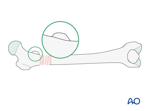 Antegrade nailing – Subtrochanteric femoral fracture – Intraoperative radiological assessment