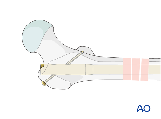 Antegrade nailing – Subtrochanteric femoral fracture – Nail locking - general considerations