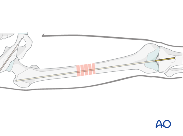 Femoral shaft – Retrograde nailing – Guide wire insertion