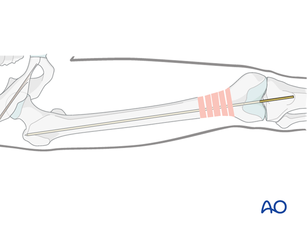 Femoral shaft – Retrograde nailing – Guide wire insertion
