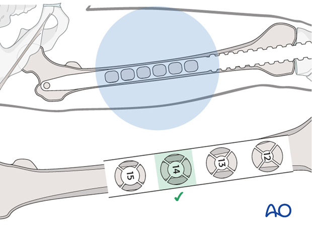Femoral shaft – Retrograde nailing - Nail length and diameter using radiographic ruler
