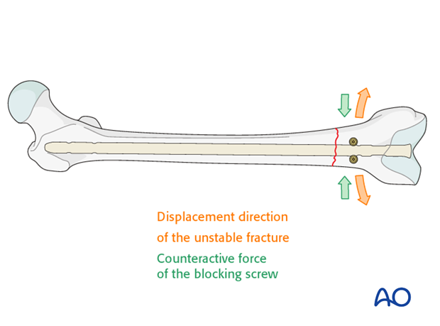 Poller screw (blocking screw) in distal transverse fractures