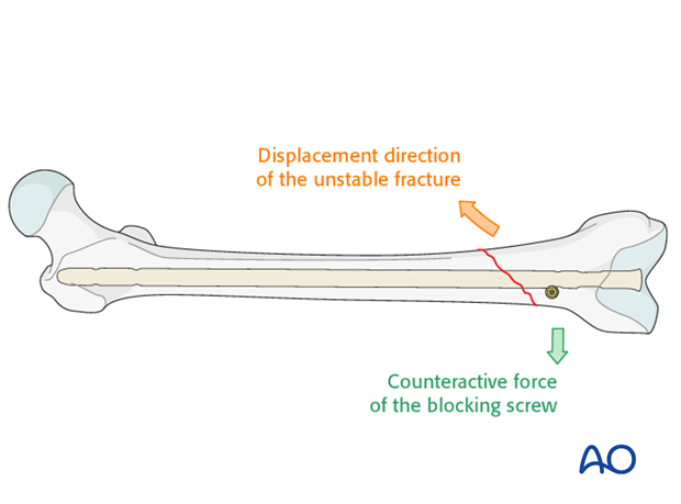 Poller screw (blocking screw) in distal oblique fractures