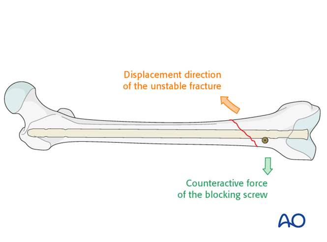 Retrograde nailing for Simple, transverse, distal 1/3 fractures