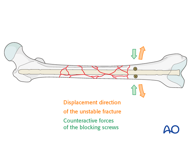 Poller screw (blocking screw) in midshaft comminuted fractures
