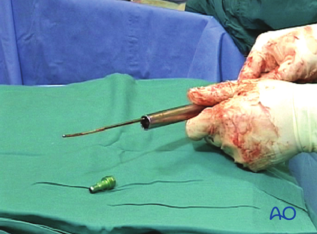 Femoral shaft – Retrograde nailing – Insertion of the end cap
