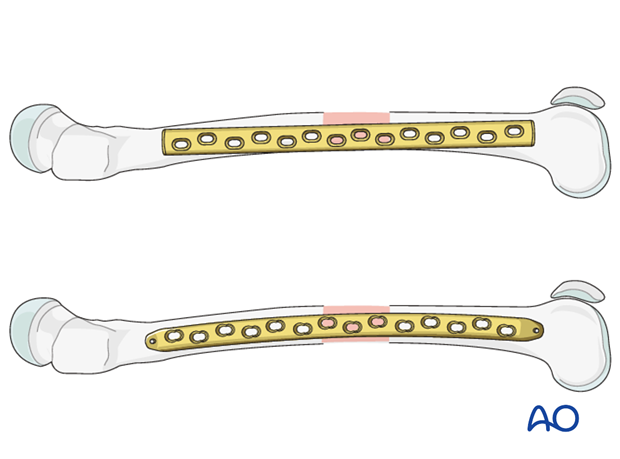 最も完璧な Segmental, for plating Bridge - ORIF fragmentary, fractures 1/3 middle テーブル・チェア・ハンモック