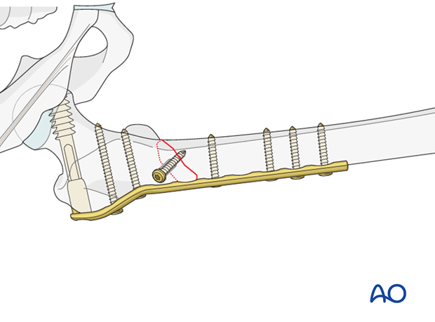 Plate fixation to distal fragment