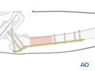 segmental fragmentary proximal 1 3 fractures
