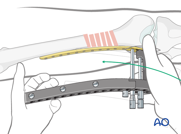 Distal femoral shaft fracture – Minimally invasive LISS bridge plate - Plate insertion