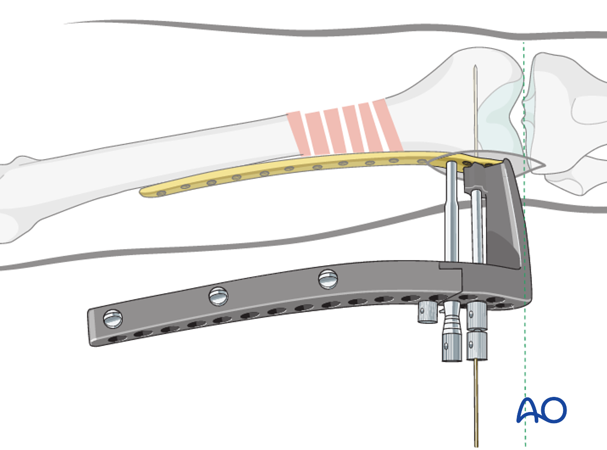 MIO - Bridge Plating (LISS Or LCP) For Segmental, Fragmentary, Distal 1 ...