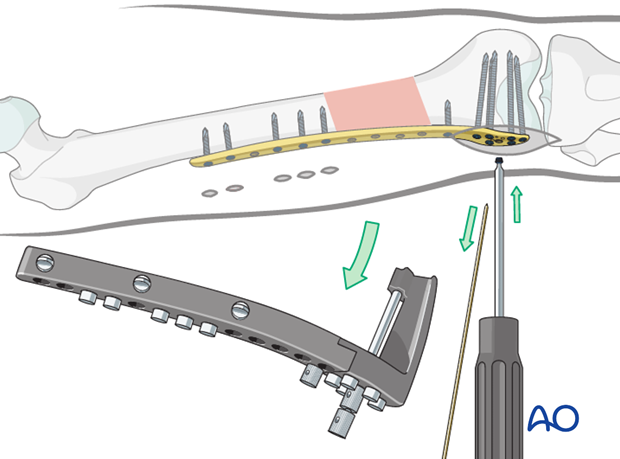 Distal femoral shaft fracture – Minimally invasive LISS bridge plate - Additional screw insertion