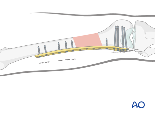 Distal femoral shaft fracture – Minimally invasive LISS bridge plate - Wound closure