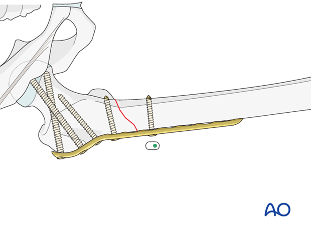 Plate fixation to distal fragment