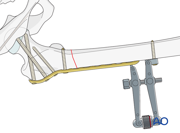 Plate fixation to distal fragment