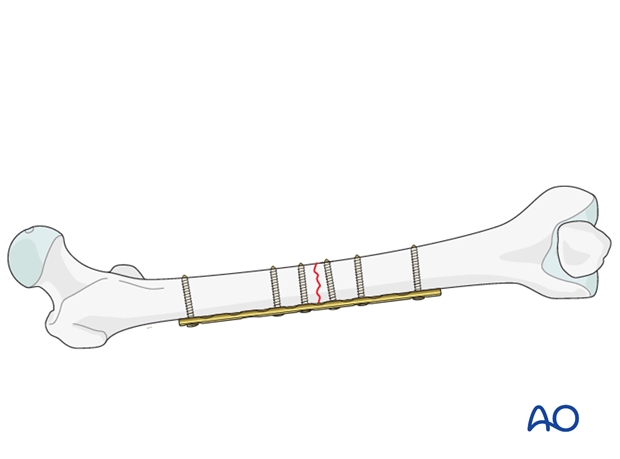 Transverse fracture of femoral shaft – Compression plate – Final fixation