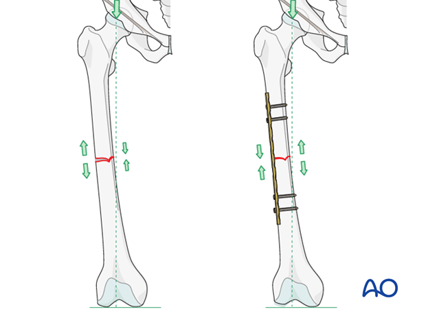 Transverse fracture of femoral shaft – Compression plate – Plate position