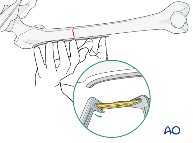 Transverse fracture of femoral shaft – Compression plate – Contouring the plate